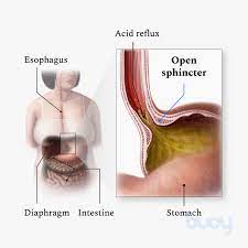 This nclex review will discuss gerd (gastroesophageal reflux disease). Acid Reflux Gerd Symptoms Diet Finding Relief Buoy