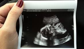 The nt scan is an ultrasound done in the first trimester to determine your baby's risk of having down syndrome and some other chromosomal abnormalities. Nuchal Translucency Scan Foresight Prenatal Clinic Bangladesh