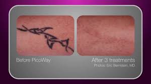 Tolitano was born in the bridgeport neighborhood of chicago and is actively involved in the community. Tattoo Removal Reset Medspa Chicago Il