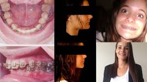 ♡ Mon Opération Maxillo faciale Avant