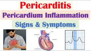 Image result for Pericarditis