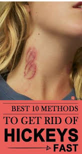 Hickeys are really just a bruise and the ice slows the. 71 Style Fashion Ideas How To Hide Hickeys Hickeys Hickie Removal