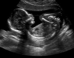 Je viens de faire ma deuxième échographie est déjà, le plus important à savoir de cette deuxième échographie est que bébé2 va bien, il bouge bien, il grossi bien, même trop vite à mon goût (il est. Deuxieme Echographie