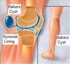 Pin On All About Knee Pain