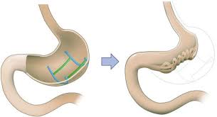 Gastric Outlet Reduction TORe procedure