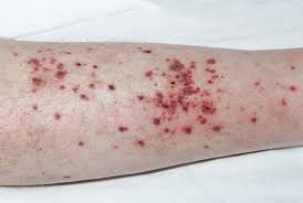 Image result for Vasculitis