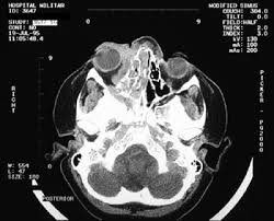 La mucormicosis rinocerebral es una complicación vital producida por la infección fúngica de los la mucormicosis pulmonar es una manifestación clínica que ocurre tras la inhalación de esporas en. Mucormicosis Rinocerebral Sobrevida En Un Nino Con Leucemia