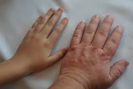 Image result for Acromegaly