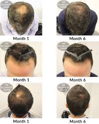Farah says minoxidil is a common option for hair loss treatment that doesn't require a prescription. Hair Growth Success Very Impressed With The Results In Just 6 Months