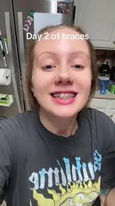 Light Violet Braces Color