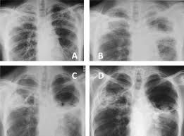 Aspergillosis fungal infections can occur in the ear canal, eyes, nose, sinus. The Clinical Spectrum Of Pulmonary Aspergillosis Thorax