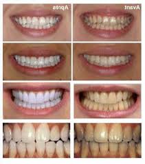 # charbon de bois #glande pinéale #kemite #noir abonnez vous à ma chaîne pour des pensées alternatives sur des sujets divers et variés !!. Bons Plans Blanchir Les Dents Charbon De Bois Support