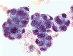 Carcinoma definition, a malignant and invasive epithelial tumor that spreads by metastasis and often recurs after excision; What Is An Adenocarcinoma