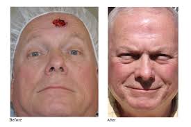 The appeal of this surgery is the small area affected during the procedure, and the high cure rate it offers. Mohs Surgery Before After Los Angeles Ent Physicians