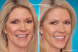 How wide should your grin be, and what if it's crooked? Correcting A Worn Slanted Crooked Smile