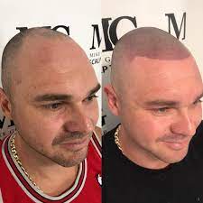 A hair tattoo performed by atl scalp micro in atlanta, ga. Mike Gunner Hairline Tattoos Smp Posts Facebook