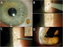 Image result for Eye Foreign Body