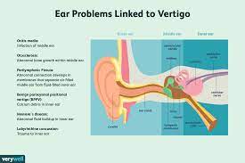 Turn your head 45 degrees to the right. Vertigo Overview And More