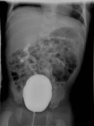 Image result for Voiding Cystourethrogram