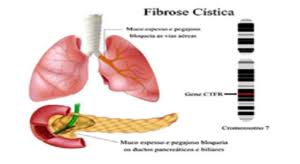 Fibrose quística a fibrose quística é uma doença hereditária que pode afetar vários órgãos e sistemas, sobretudo os sistemas respiratório, digestivo e reprodutor. Fibrose Cistica Biblioteca Virtual Em Saude Ms