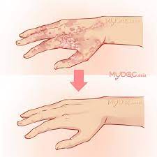 Penyakit kulit lain yang sederhana untuk pandangan kedua. 72 Klinik Rawatan Ekzema Psoriasis Terbaik Malaysia Harga Ulasan