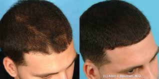The best prp results for hair loss are often seen after four months after the start of treatment. Prp Platelet Rich Plasma Therapy Acell Biod Ecms Bauman Medical