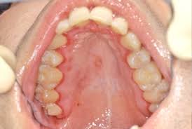 Image result for Oral herpes roof of mouth