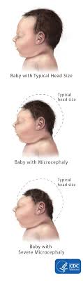 Facts About Microcephaly Cdc