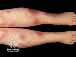 Image result for erythema nodosum