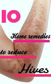 Arm Covered In A Skin Allergy Hives Skin Allergy Home Remedy Home Remedies For Allergies Home Remedies For Hives