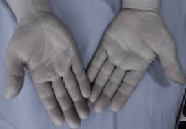 Crps Complex Regional Pain Syndrome Upper Limb Surgery