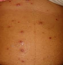 Primary varicella infection (chickenpox) was not reliably distinguished from smallpox until the end of the 19th century. Varicella Chickenpox Postvaricella Encephalitis Varicella Hemorrhagic Pneumonitis Postvaricella Myelitis Varicella With Other Specified Complications Varicella With Unspecified Complication Varicella Without Mention Of Complication