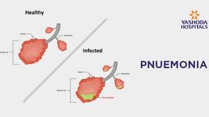 Pneumonia is not contagious, but the germs that you can encounter the germs that cause pneumonia in the most common of places, and the environment you. Pneumonia Types Causes Symptoms Diagnosis And Treatment