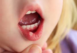 The cold temperature will make your blood vessels constrict, which will reduce swelling and stop the internal bleeding. Mouth Ulcers Hse Ie