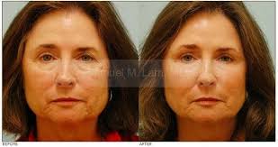 Mole Removal Photo Facial Mole Removal And Facial Excisions Procedures By Dr Samuel Lam Lamfacialplastics L Facial Mole Removal Mole Removal Facial Mole