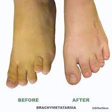 Pin On Brachymetarsia A Condition In Which I Suffered With For Years