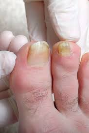 We did not find results for: Why Are My Toenails Yellow Causes And Treatment