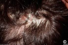 Image result for white scabs on the head in children