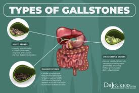 How To Beat Gallstones Naturally Drjockers Com In 2020 Gallstones Calming Food Gallstone Diet