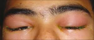 Image result for Dacryoadenitis