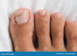 Image result for Onycholysis feet