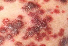 Without cd4 cells, your body has a hard time fighting off diseases. What Are Hiv Aids Symptoms Treatment And Prevention
