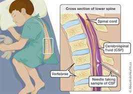Salah satu penyebab paling umum dari kompresi tulang belakang adalah memakai bertahap dan air mata dari osteoarthritis. Ramai Percaya Ambil Air Tulang Belakang Boleh Lumpuh Doktor Jelaskan Mitos Berleluasa Ini Remaja
