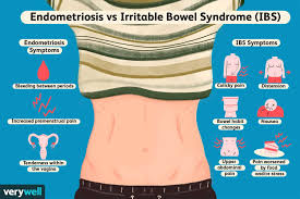 Common signs and symptoms of endometriosis include: The Differences Between Endometriosis And Ibs