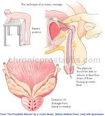 Prostate massage is the massage or stimulation of the male prostate gland for medical purposes or sexual stimulation. Prostate Massage And Ucpps Prostatitis Cpps Ucpps Prostatitis Interstitial Cystitis Forum