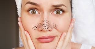 Les points noirs, qu'on appelle également comédons, surviennent lorsque les pores de la peau sont obstrués par un excès de sébum et de cellules on retrouve principalement les points noirs dans les régions où se situent les glandes sébacées, qui produisent le sébum. 12 Conseils Pour Lutter Contre Les Points Noirs Et Les Pores Dilates Au Naturel