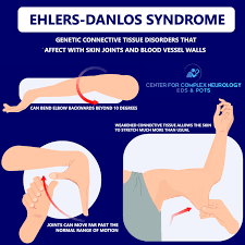 Image result for Connective Tissue Disorder