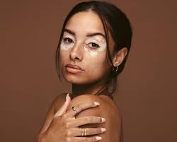 Image result for Vitiligo