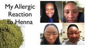 Free shipping for orders over $40 Health Vlogger Shares Photos After Scary Allergic Reaction To Henna Hair Dye
