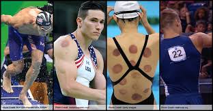 Cupping saleh #حجامة_صالح a way to identify cupping therapy points by employing thermal changes examination techniques to detect points associated with the. Cupping Therapy On The Pga Tour Considerations And Concerns Article Tpi